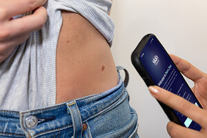 The AI from Skin Analytics that caught 20,000 cancers in the UK is now certified for use on a standard smartphone